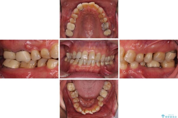 歯列不正と歯周病　総合歯科治療による全顎治療 治療前画像