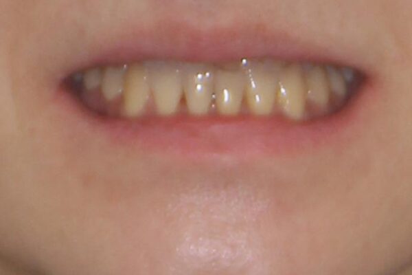 反対咬合で痛む前歯を改善　インビザラインによる矯正治療 治療後画像