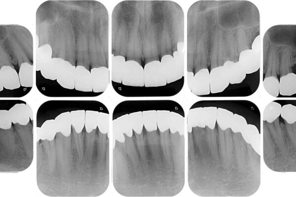 とにかく作り物のような真っ白な歯にしたい　フルジルコニアクラウンによる補綴治療 治療後画像