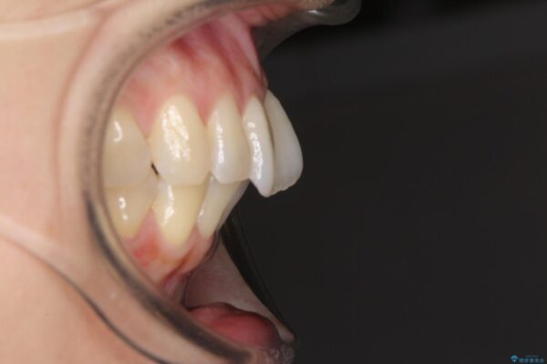 短期間で仕上げたい　ワイヤーでの非抜歯矯正 治療前画像