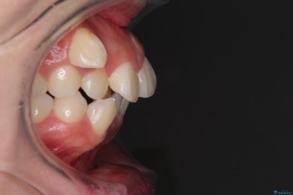 著しい叢生と顎骨のズレ　ワイヤー装置による抜歯矯正 治療前画像