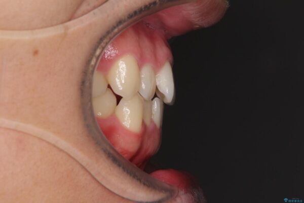 狭い歯列と前歯のデコボコ　インビザラインによる矯正治療 治療前画像
