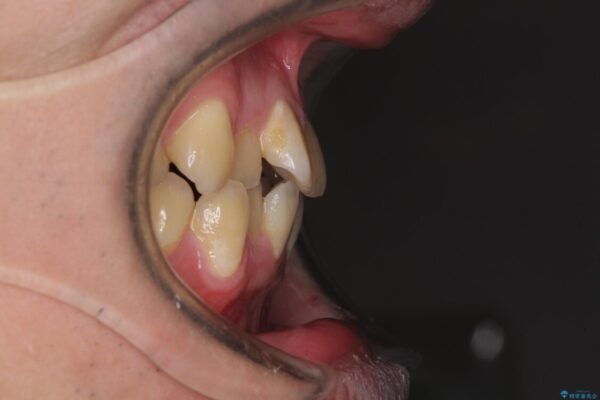 歯列全体のクロスバイトを治したい　ワイヤー装置による矯正治療 治療前画像
