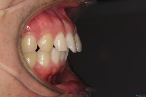 上顎の出っ歯とすきっ歯　補助装置を用いたインビザライン矯正 治療前画像