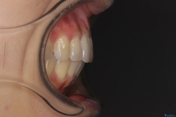 短期間で仕上げたい　ワイヤーでの非抜歯矯正 治療後画像