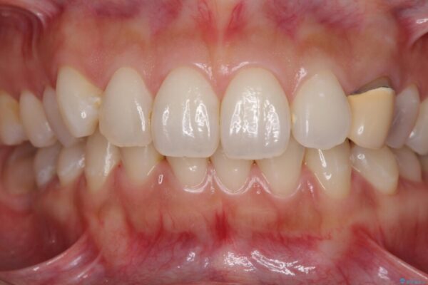 保険診療の変色したクラウン　前歯の審美歯科治療 治療前画像
