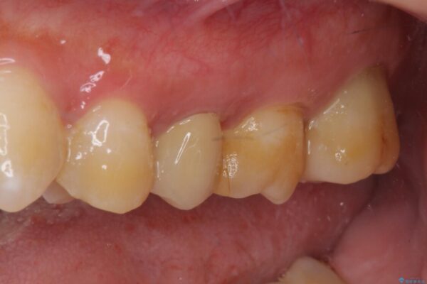 冷たいものがしみる　神経組織の一部を除去した虫歯治療 治療後画像