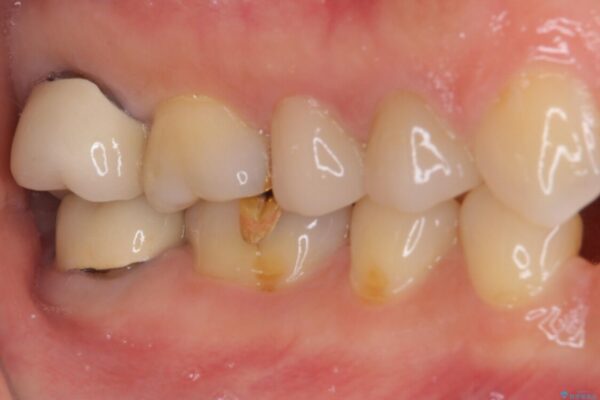 強い咬み合わせでむし歯が悪化　ゴールドインレーによるむし歯治療 治療前画像