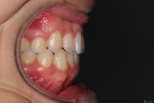 狭い歯列と前歯のデコボコ　インビザラインによる矯正治療 治療後画像