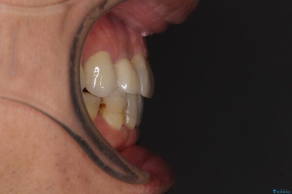 歯列不正と歯周病　総合歯科治療による全顎治療 治療後画像