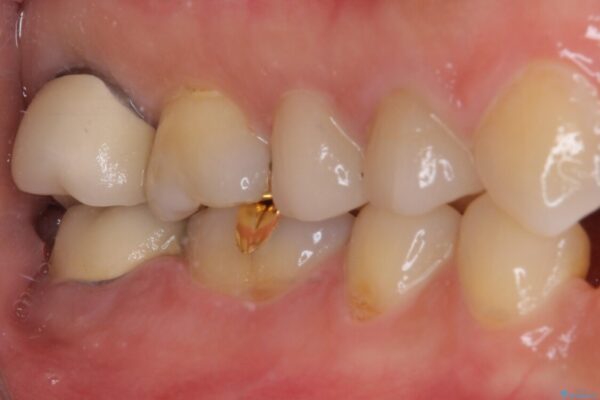 強い咬み合わせでむし歯が悪化　ゴールドインレーによるむし歯治療 治療後画像