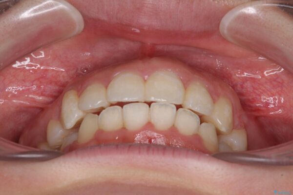 著しい叢生と顎骨のズレ　ワイヤー装置による抜歯矯正 治療後画像