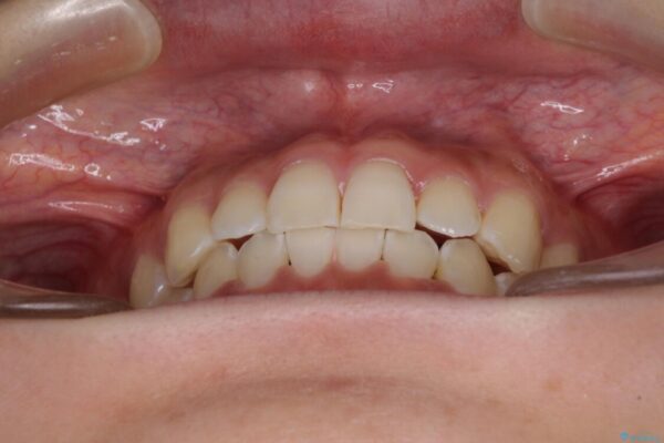 乳歯を抜いてインプラントに　咬み合わせ改善のインビザライン矯正 治療後画像