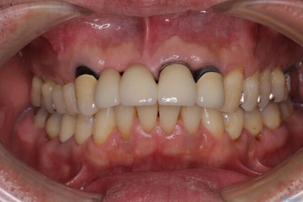 話しにくく見栄えの悪い前歯　オールセラミックブリッジ 治療前画像