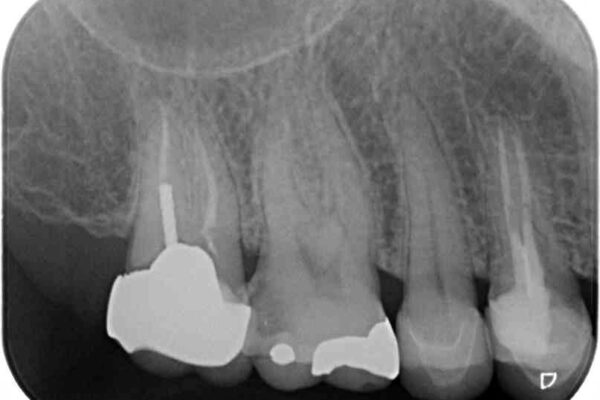 強い咬み合わせでむし歯が悪化　ゴールドインレーによるむし歯治療 治療前画像