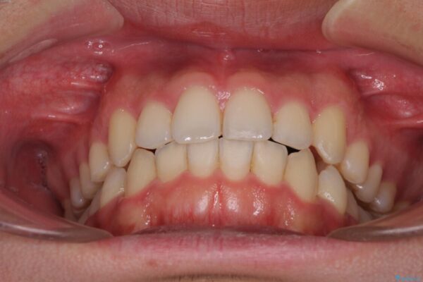 狭い歯列と前歯のデコボコ　インビザラインによる矯正治療 治療途中画像