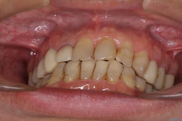 歯列不正と歯周病　総合歯科治療による全顎治療 治療途中画像