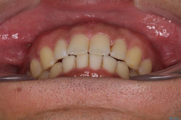 上顎の出っ歯とすきっ歯　補助装置を用いたインビザライン矯正 治療後画像