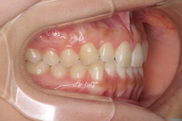 乳歯を抜いてインプラントに　咬み合わせ改善のインビザライン矯正 治療前画像