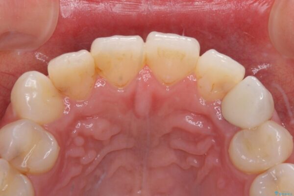 保険診療の変色したクラウン　前歯の審美歯科治療 治療後画像