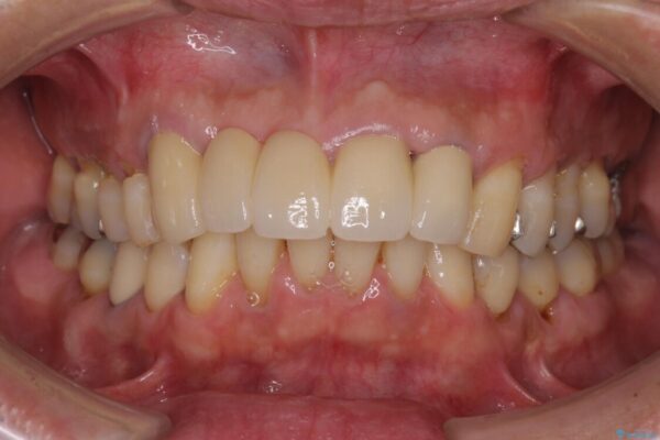 話しにくく見栄えの悪い前歯　オールセラミックブリッジ 治療後画像