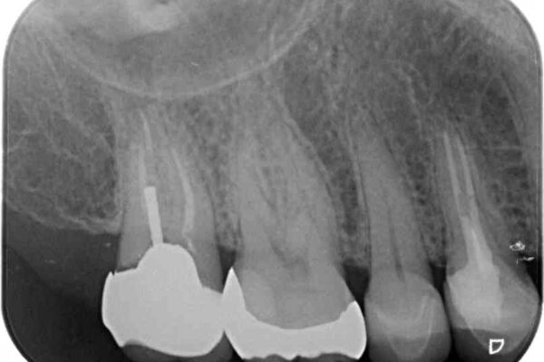 強い咬み合わせでむし歯が悪化　ゴールドインレーによるむし歯治療 治療後画像