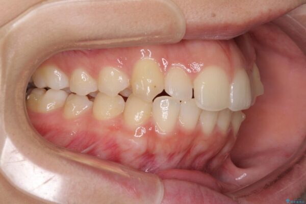 骨格的に左右にずれいている　前歯のデコボコをインビザラインで解消 治療途中画像
