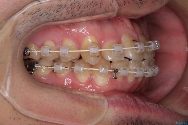 歯列全体のクロスバイトを治したい　ワイヤー装置による矯正治療 治療途中画像