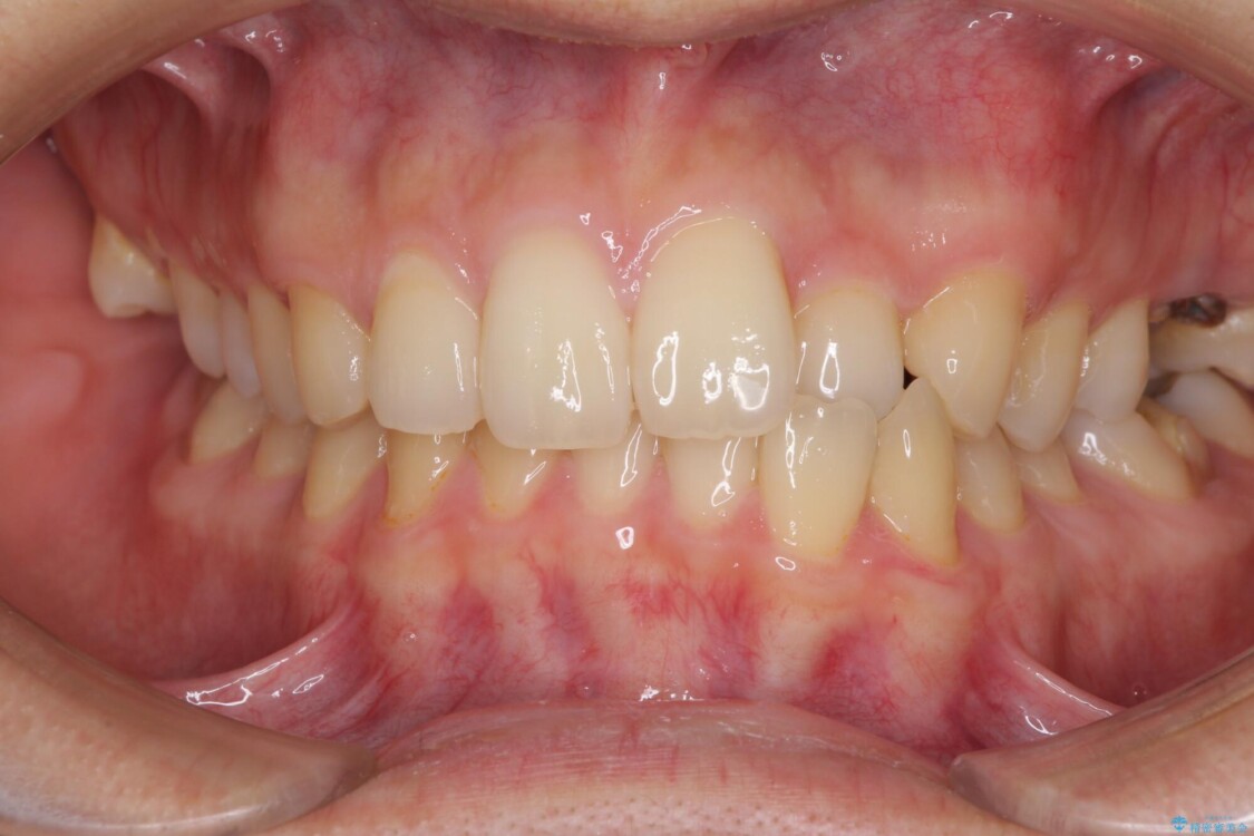 前歯のクロスバイトと抜歯が必要な奥歯の虫歯　インビザラインとインプラント治療 ビフォー