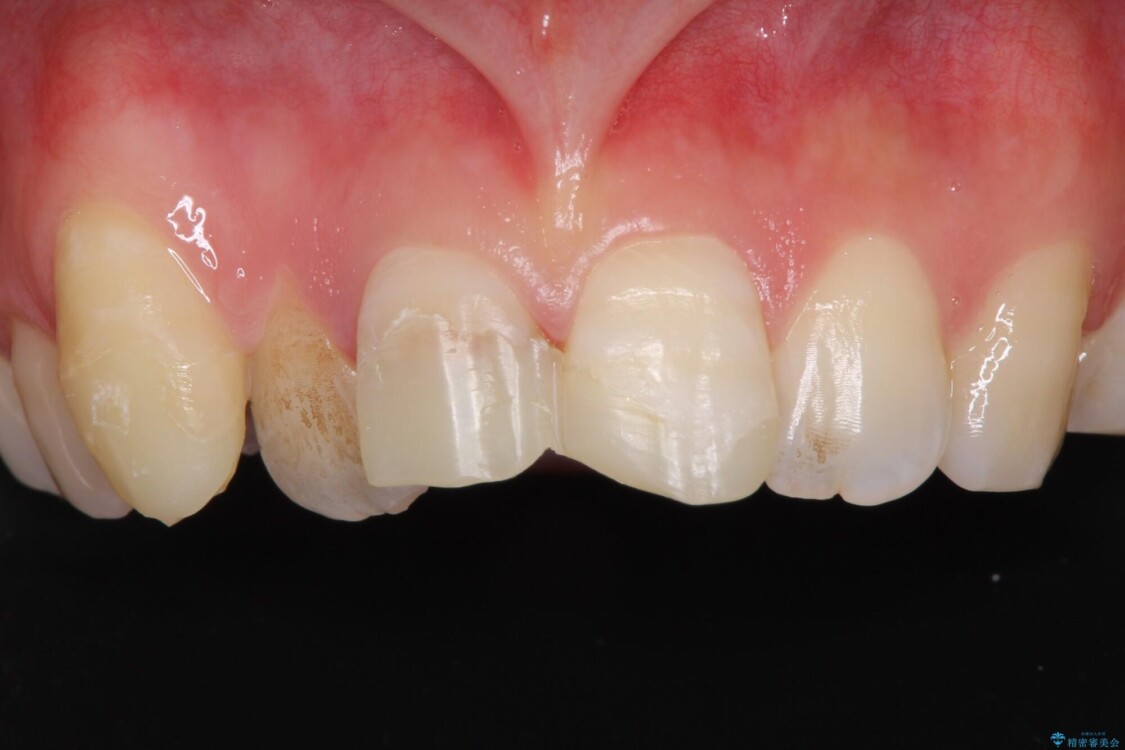 転んで前歯が欠けた　折れた前歯をきっかけに矯正治療で歯列をきれいに整える 治療前