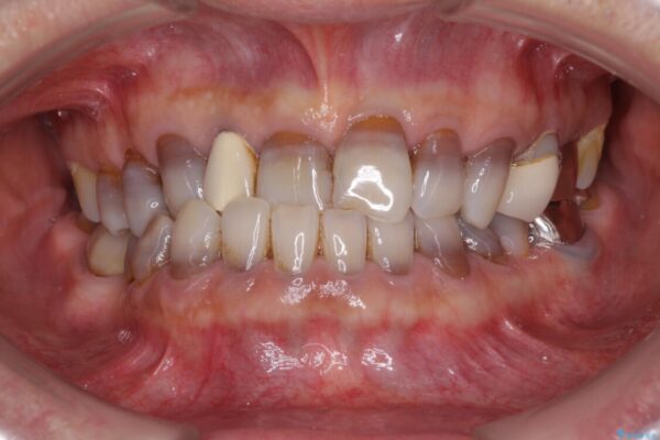 下の歯が前に出てしまう咬み合わせを治したい　インビザラインによる矯正治療 ビフォー