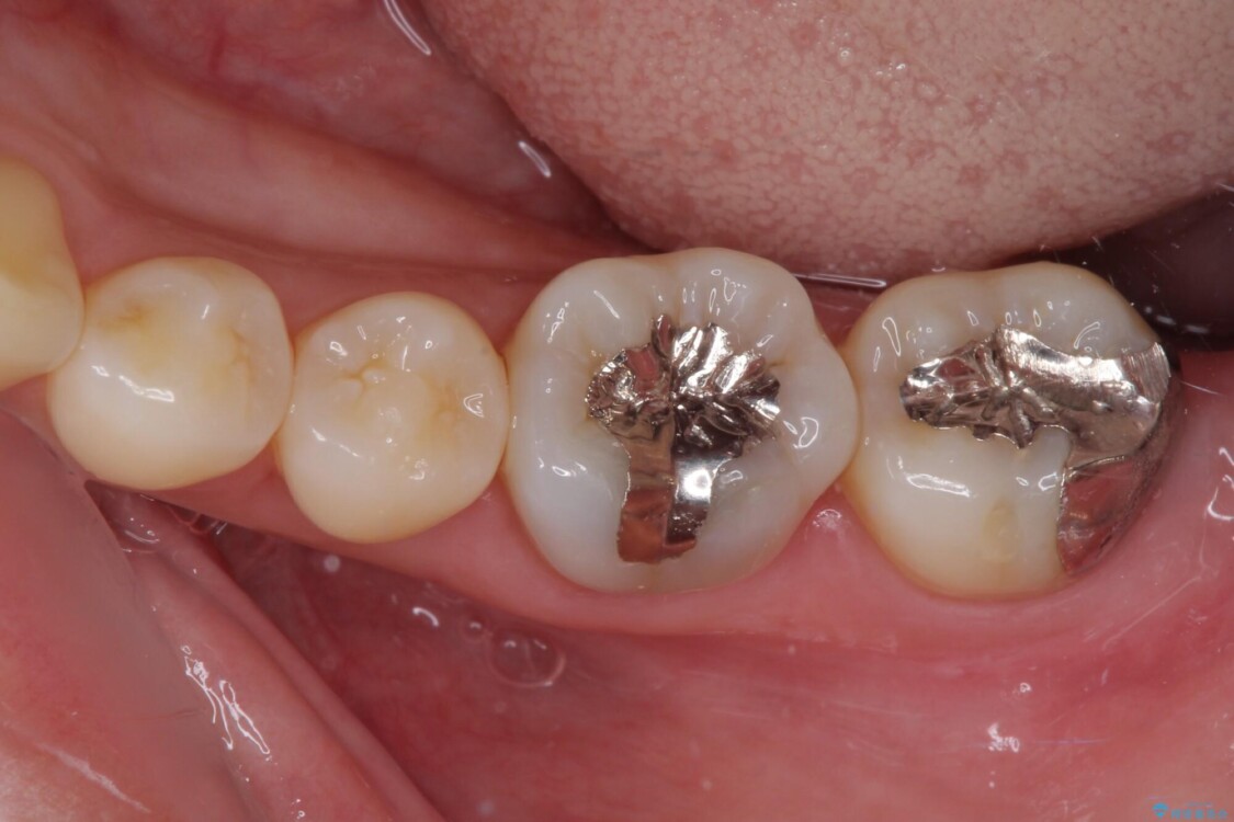 奥歯が痛い　保険治療後に症状が発現した歯のむし歯治療 ビフォー