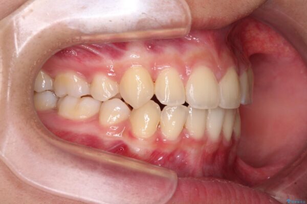 気がつくと口が開いてしまう　閉じにくい口元改善の抜歯矯正 治療後画像