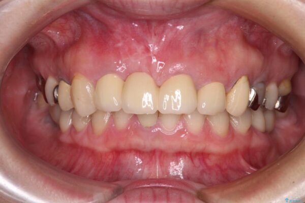 鼻の下を押すと痛い　抜歯を避けてきた歯を抜歯して自然な口元に 治療後画像
