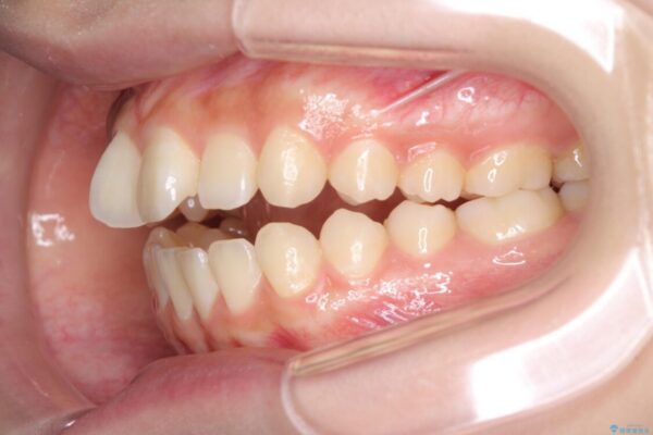 話しにくいオープンバイト　ワイヤー装置による抜歯矯正治療 治療前画像