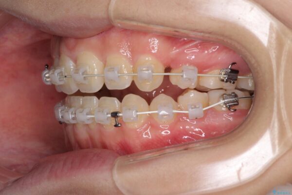 話しにくいオープンバイト　ワイヤー装置による抜歯矯正治療 治療途中画像