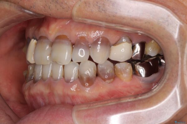 下の歯が前に出てしまう咬み合わせを治したい　インビザラインによる矯正治療 治療前画像