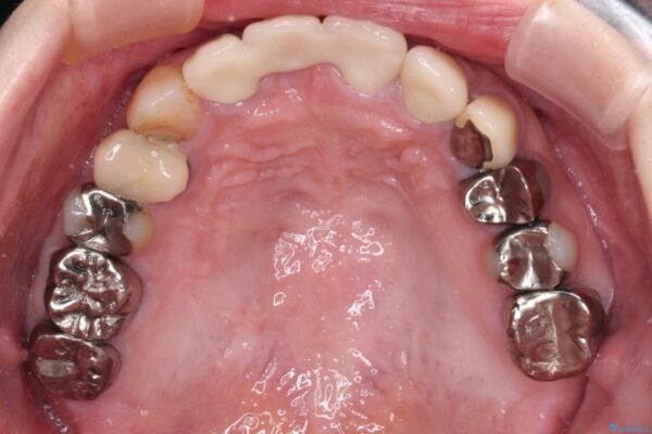鼻の下を押すと痛い　抜歯を避けてきた歯を抜歯して自然な口元に 治療後画像