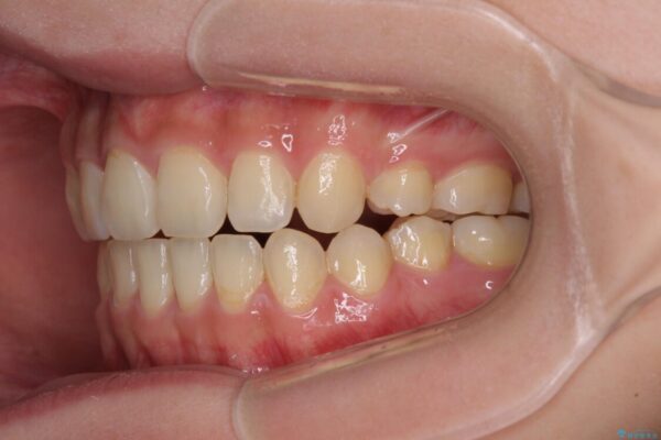 話しにくいオープンバイト　ワイヤー装置による抜歯矯正治療 治療後画像