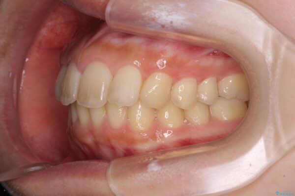 就職前にきれいな歯並びにしたい　大学生のインビザライン矯正 治療後画像