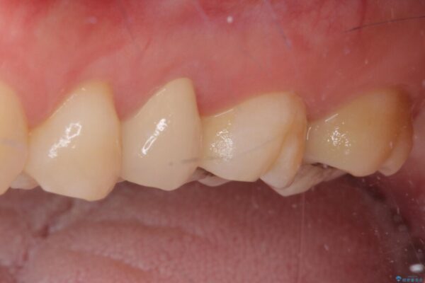 奥歯が痛い　保険治療後に症状が発現した歯のむし歯治療 治療後画像