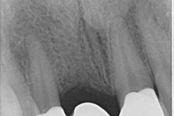 折れているのに応急処置でごまかしてきた前歯　オールセラミックブリッジによる補綴治療 治療後画像