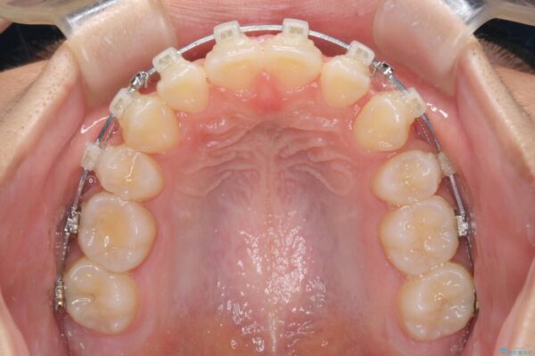 気がつくと口が開いてしまう　閉じにくい口元改善の抜歯矯正 治療途中画像
