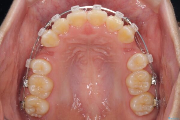 前歯が磨きにくい　目立たないワイヤー装置による矯正治療 治療途中画像