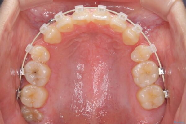 話しにくいオープンバイト　ワイヤー装置による抜歯矯正治療 治療途中画像