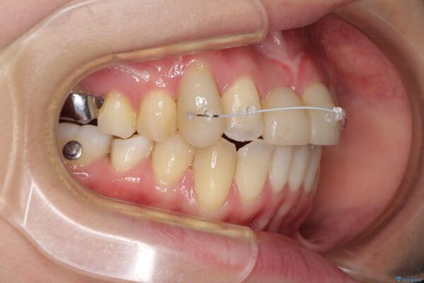 転んで前歯が欠けた　折れた前歯をきっかけに矯正治療で歯列をきれいに整える 治療途中画像