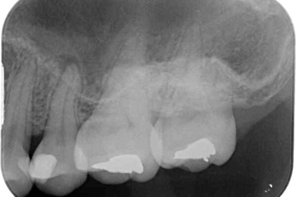 奥歯が痛い　保険治療後に症状が発現した歯のむし歯治療 治療前画像