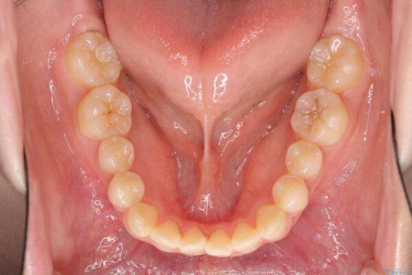 話しにくいオープンバイト　ワイヤー装置による抜歯矯正治療 治療前画像