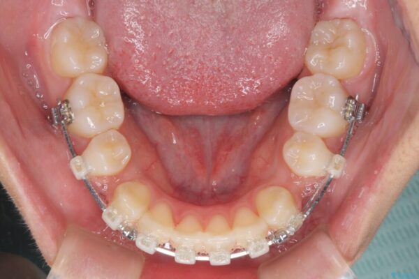 気がつくと口が開いてしまう　閉じにくい口元改善の抜歯矯正 治療途中画像
