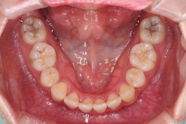 治療途中で転院　抜歯矯正の仕上げ治療 治療後画像